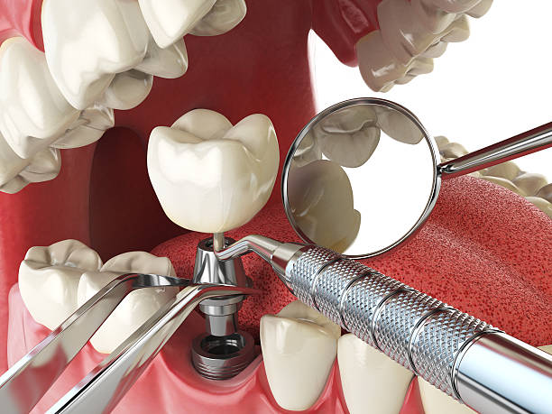Best Emergency Dental Care for Broken or Chipped Teeth in Toledo, IA