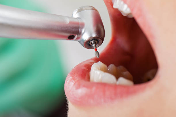 Best Emergency Tooth Extraction in Toledo, IA